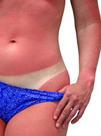 Заболевание раком кожи, вызванное солнечным ожёгом