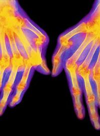 Ревматоидный артрит поражает суставы кистей